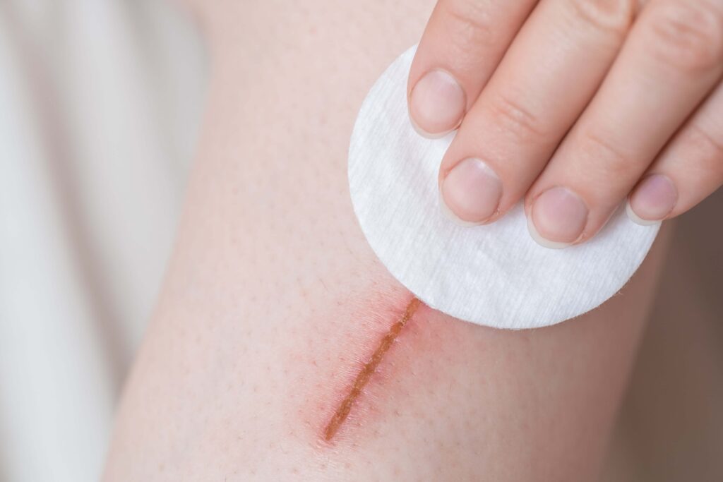 specialist caring for a wound to prevent scarring, wound healing