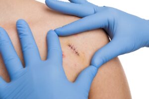 wound care specialist examining stitches