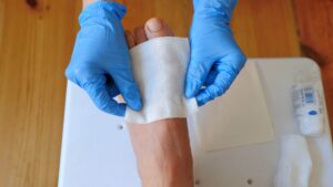 specialist treating a tunneling foot wound