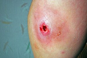 tunneling wound on a person’s arm