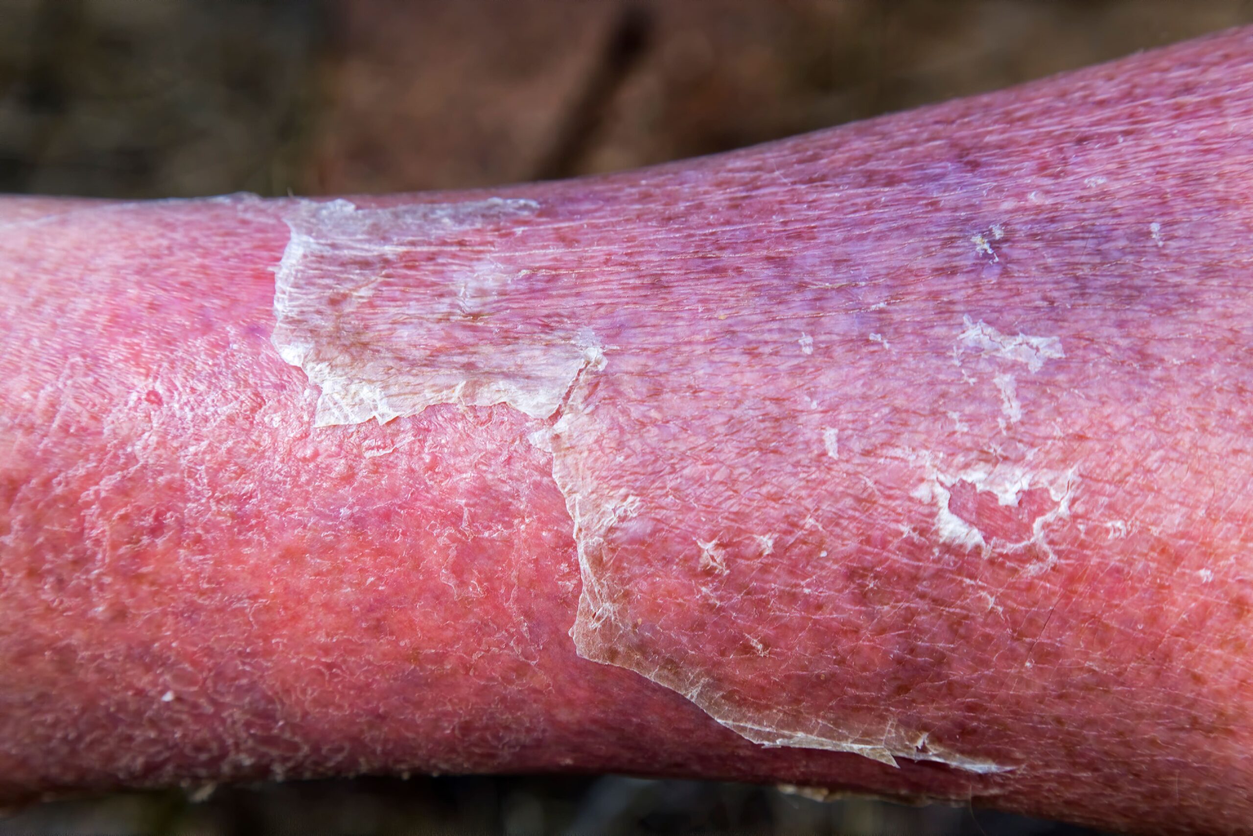 cellulitis wound on a leg