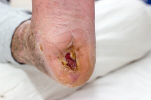 diabetic foot ulcer